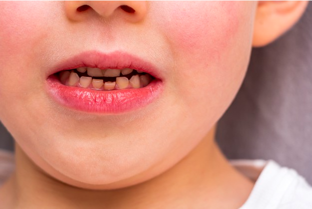Crooked Teeth
